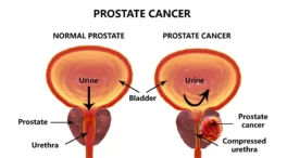 Warning signs for Prostate Cancer
